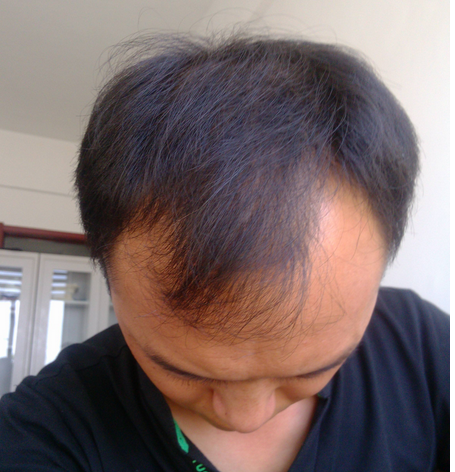 如何治疗脱发,如何防脱发_海口脱发医院