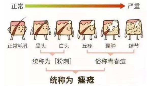 海口看粉刺医院哪家好